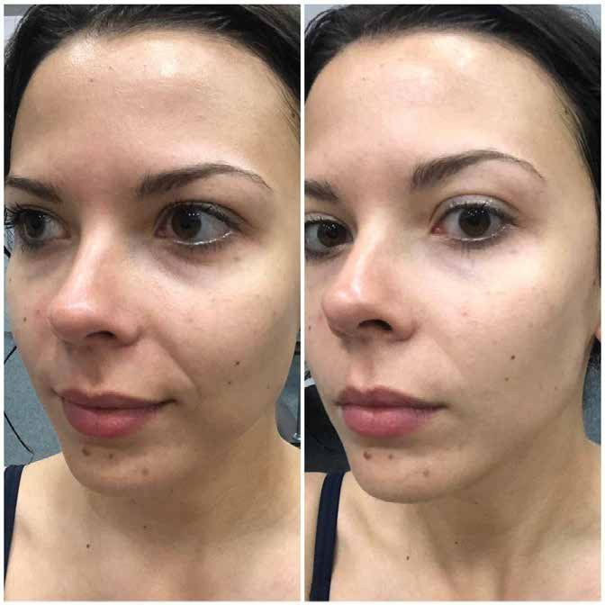 Jordi Shape - lifting facial x6